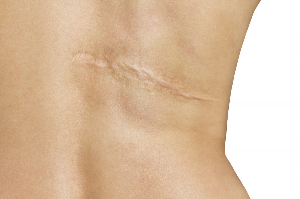 cicatriz oblicua en el lado derecho de la espalda de una persona